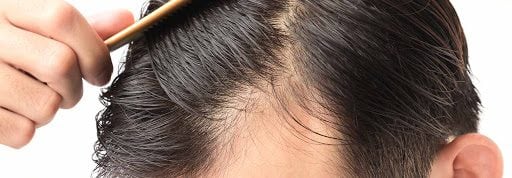 Tratamiento de Alopecia
